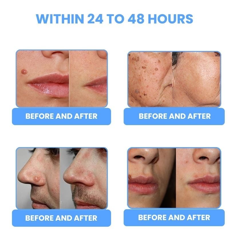 🔥 Laser Pen 🔥 Removes Warts & Moles in Just 2 Days!